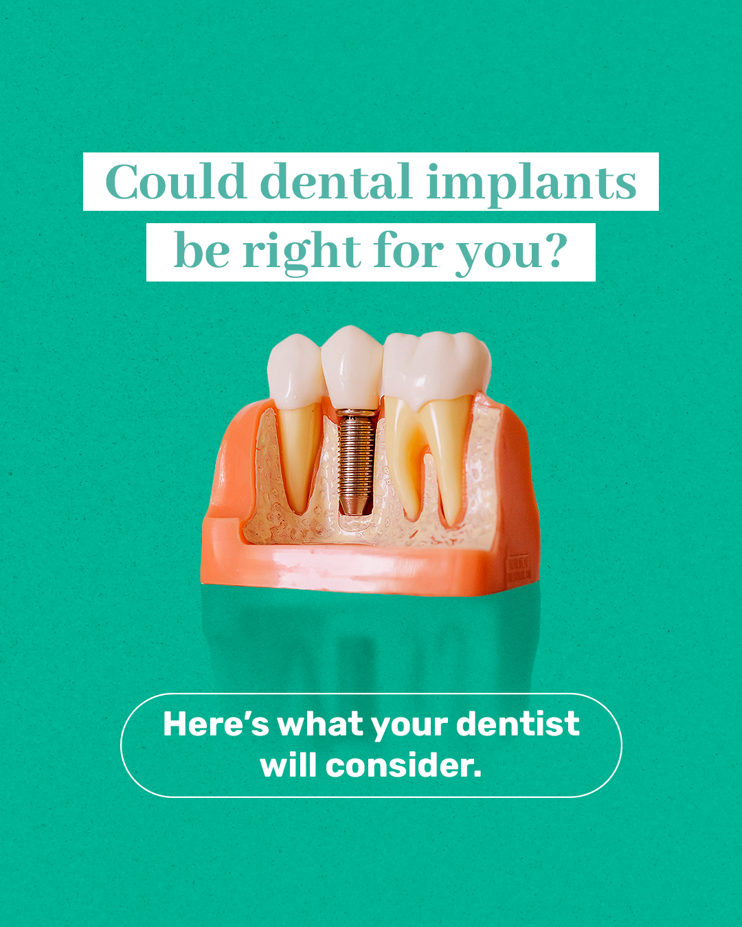 Os implantes dentários são indicados para você?