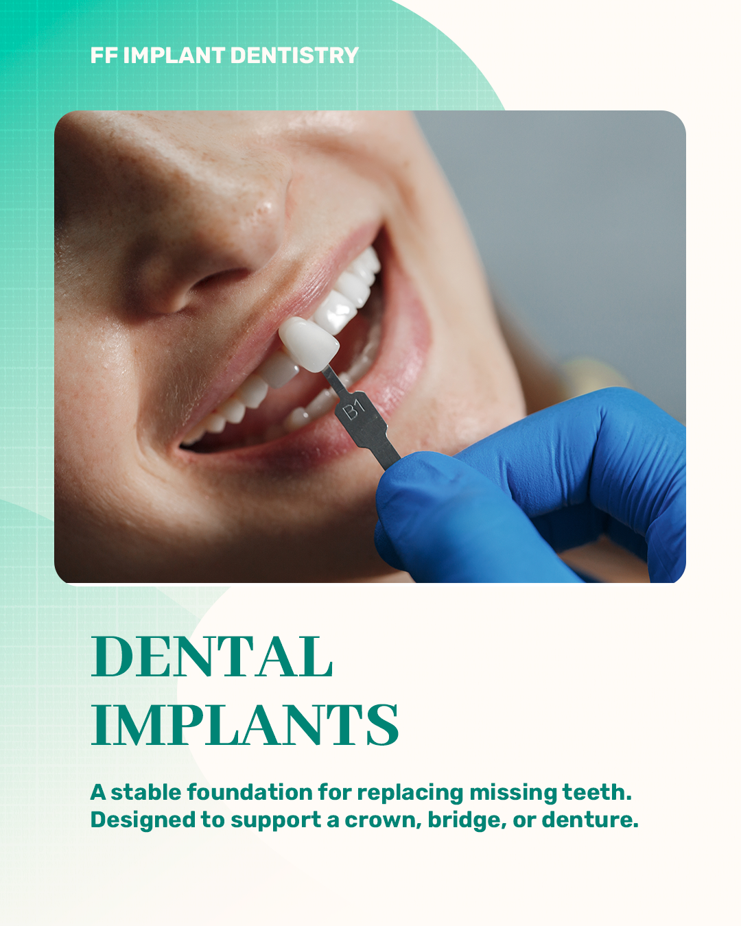 Implantes dentários