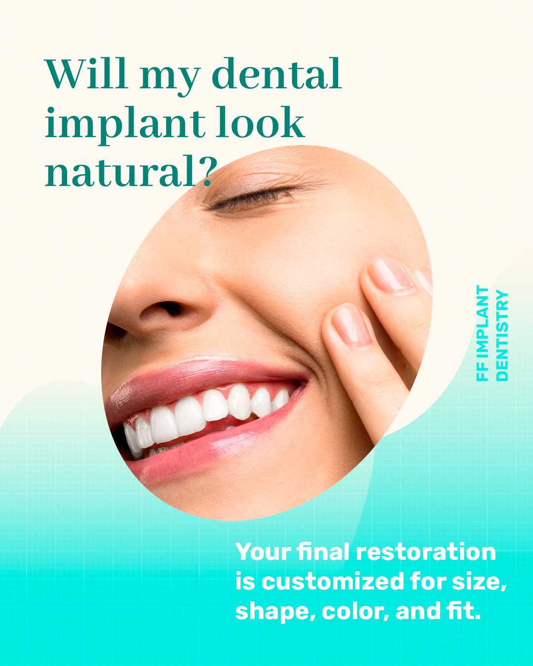 Meu implante vai parecer natural?